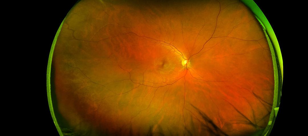 Diabetic Retinopathy: Protecting Your Vision When You Have Diabetes