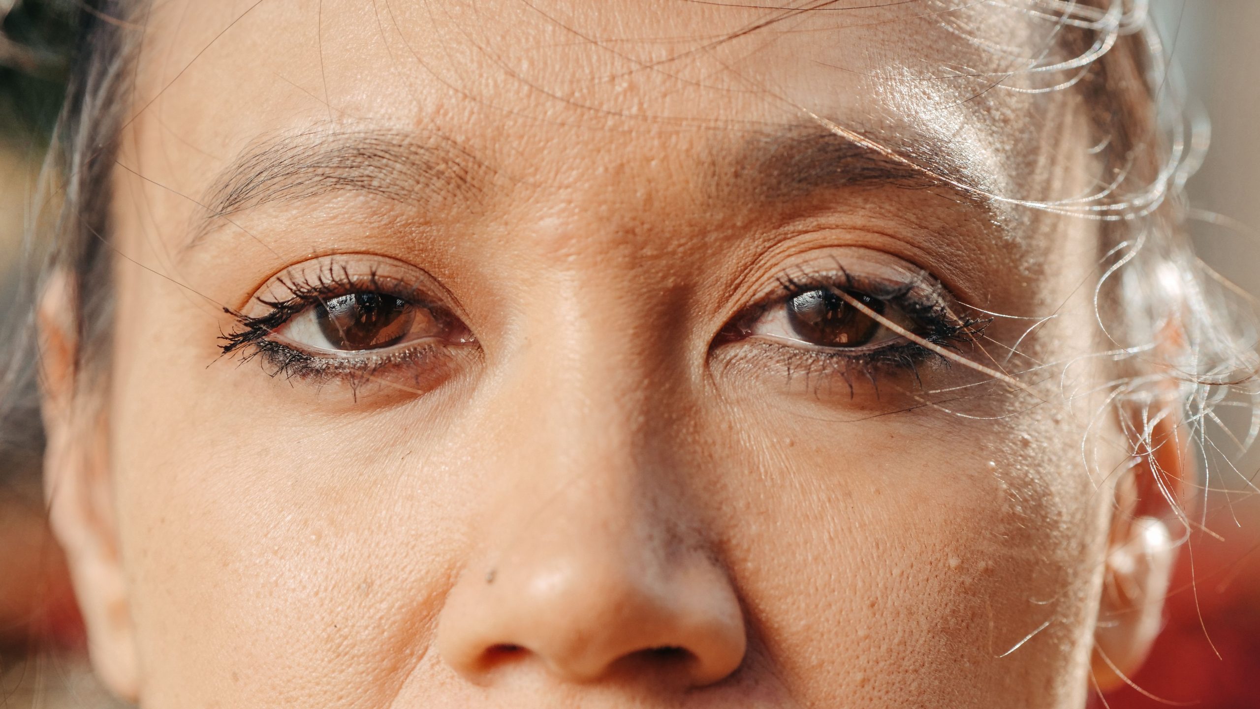 Understanding Blepharitis: Chronic Eyelid Inflammation Explained